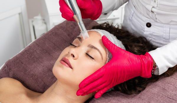 Microneedling 